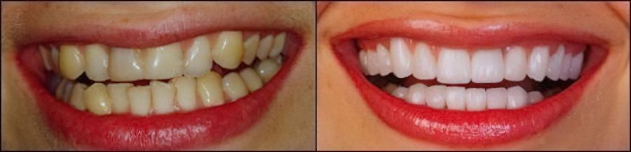 before and after veneers