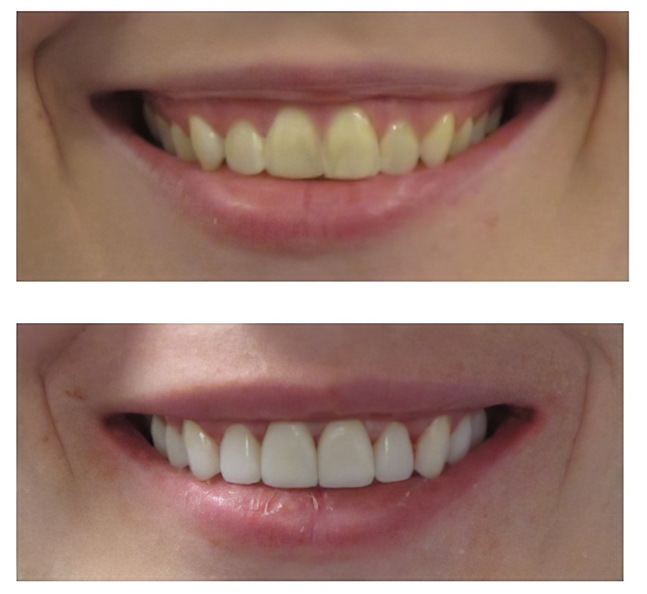 Veneers Long Island, NY Garden City, NY Garden City Smiles Louis J