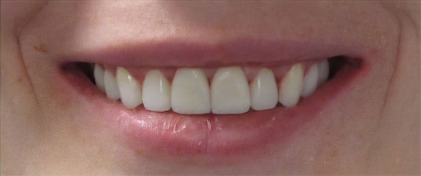After veneers procedure