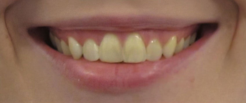 Before veneers procedure