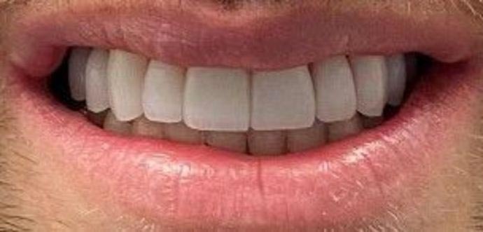 After veneers