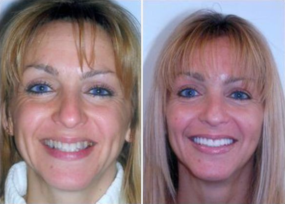 before and after cosmetic dentistry