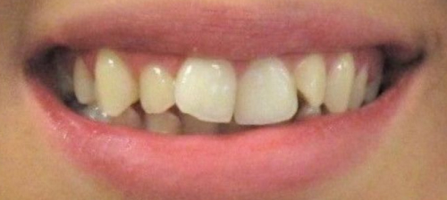 Dr. Buono's patient before Invisalign