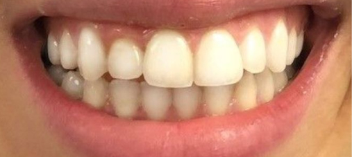 Dr. Buono's patient after Invisalign