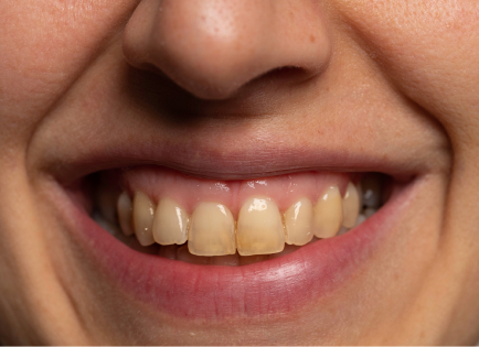 Stained teeth