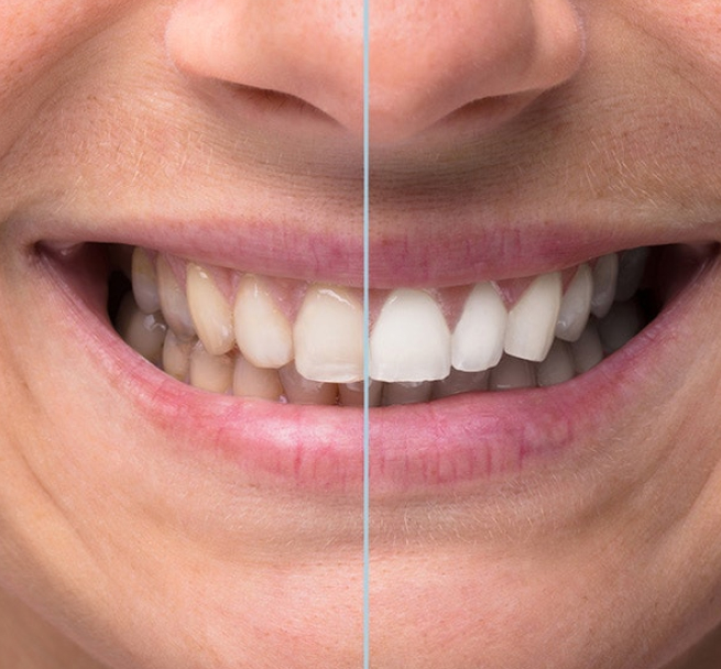 Before and after whitening