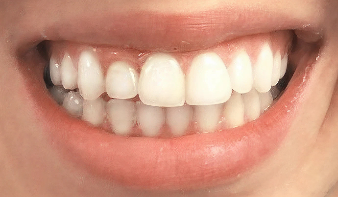 After Invisalign