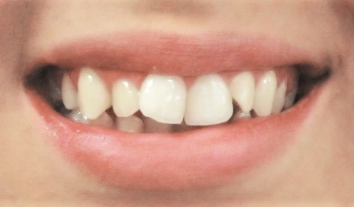 Before Invisalign