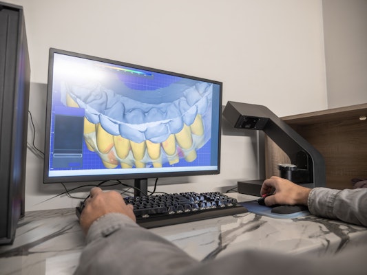 custom blueprint of veneers