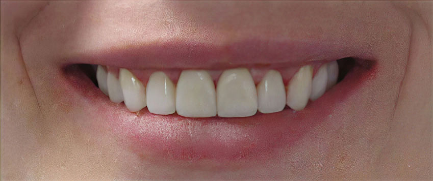 After veneers procedure