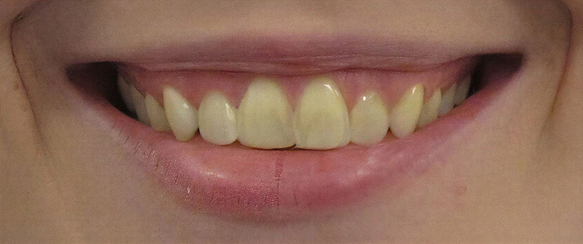 Before veneers procedure
