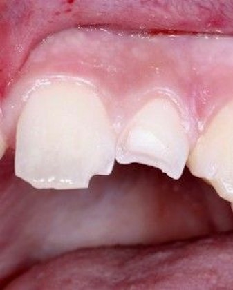 chipped tooth