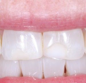 Tooth-Colored Fillings