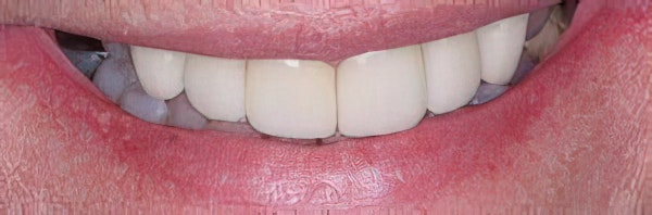 After Veneers