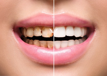 before and after whitening