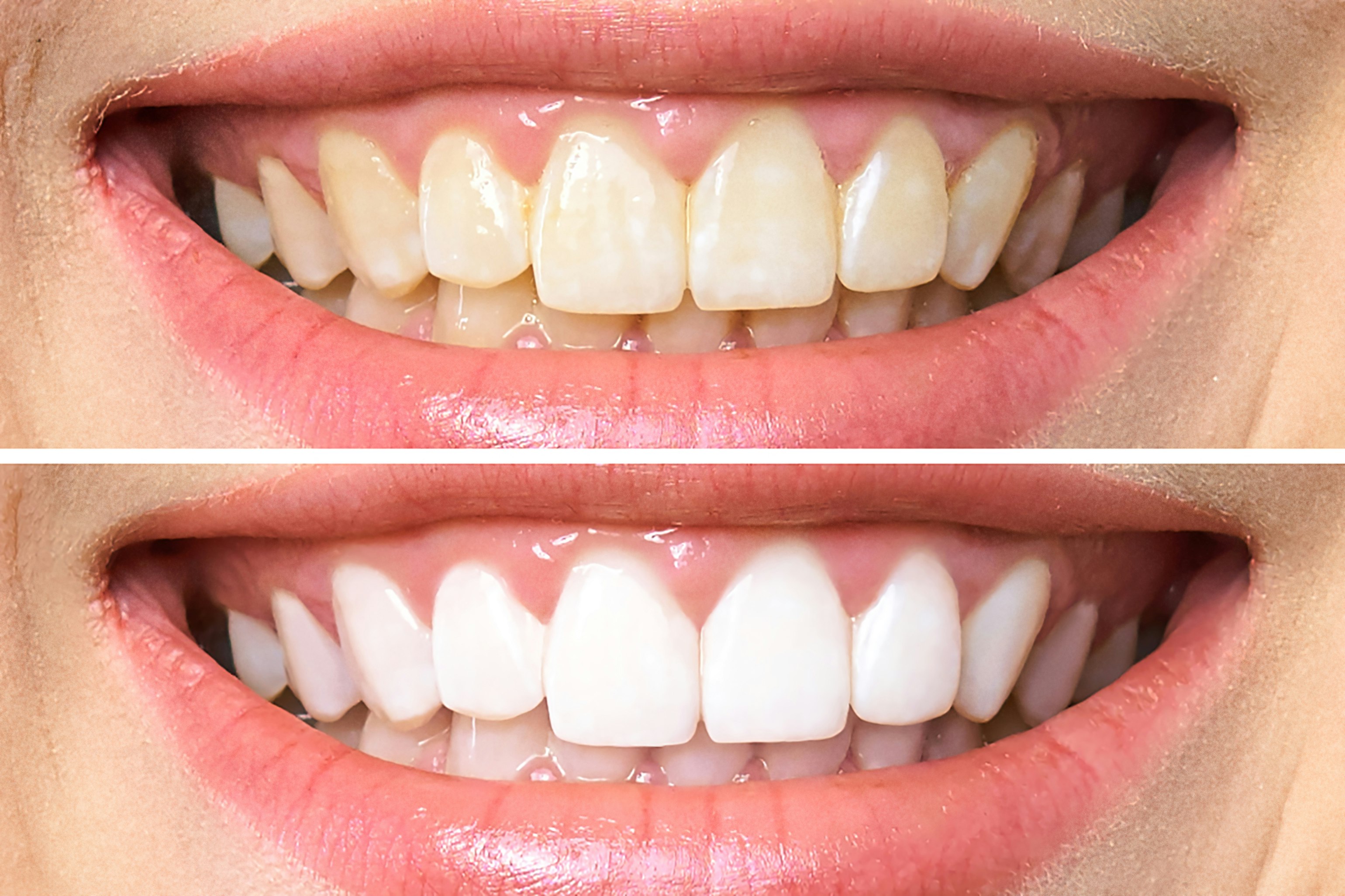 before and after whitening