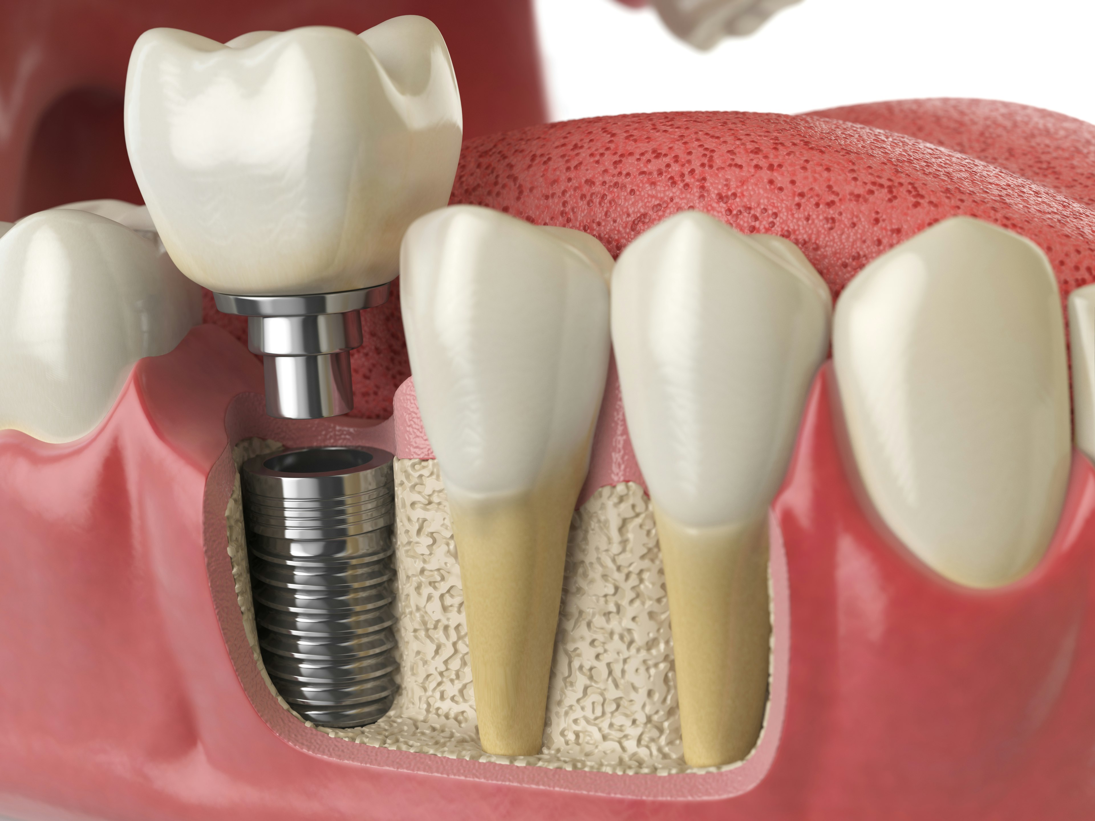Dental implant and crown, next to natural teeth