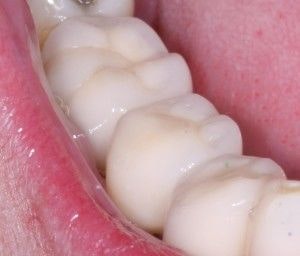 dental crowns