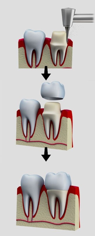 dental crowns process
