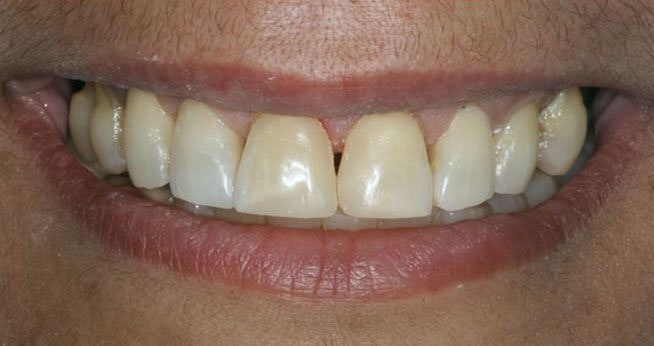 After Composite Bonding