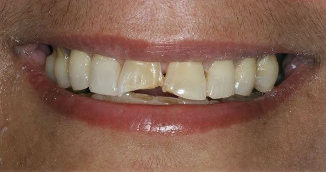 Before Composite Bonding