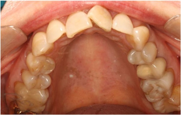 Dr. Victor Siegel's patient Before Invisalign