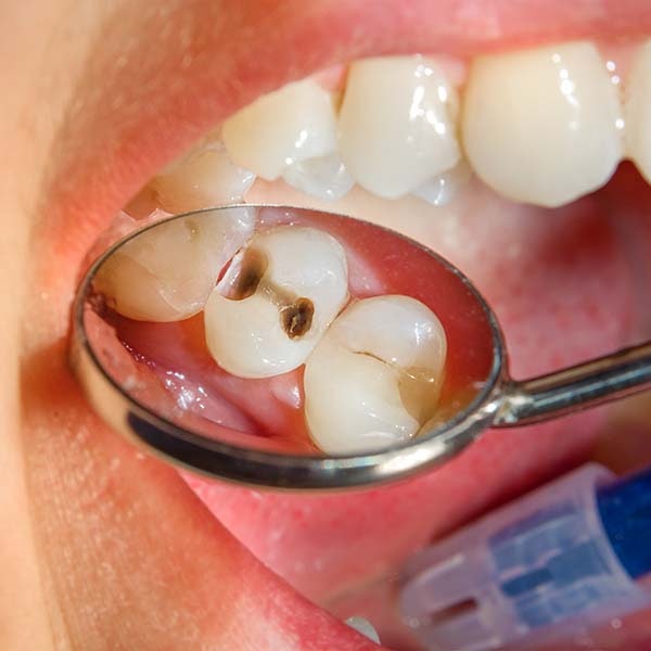 close up image of a cavity