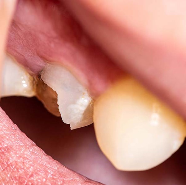 close up image of a severely broken tooth