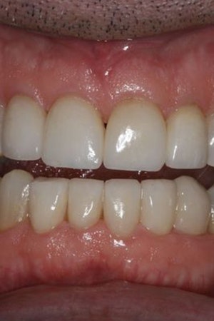 After veneers