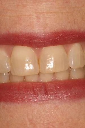 Before teeth whitening