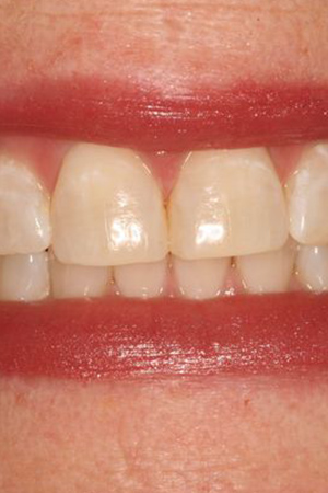 After teeth whitening