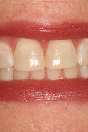 After teeth whitening