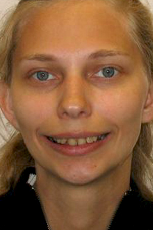 Before porcelain crowns