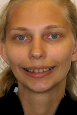 Before porcelain crowns