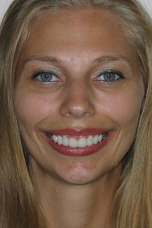 After porcelain crowns