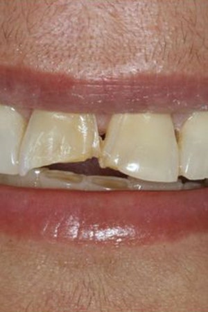 Before dental bonding