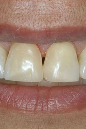 After dental bonding