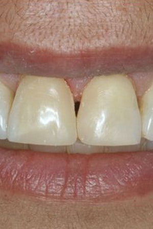 After dental bonding