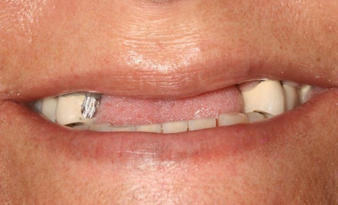 Before Dental implants