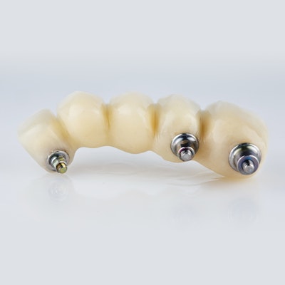An implant-supported dental bridge