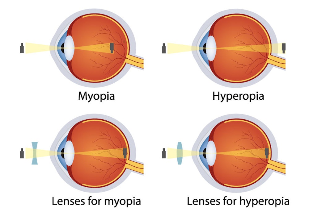 Illustration showing myopia and hyperopia and how it projects images onto your retina incorrectly and how lenses can correct this