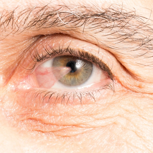 close-up of eye with a Pterygium