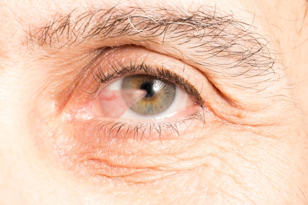 close-up of eye with a Pterygium