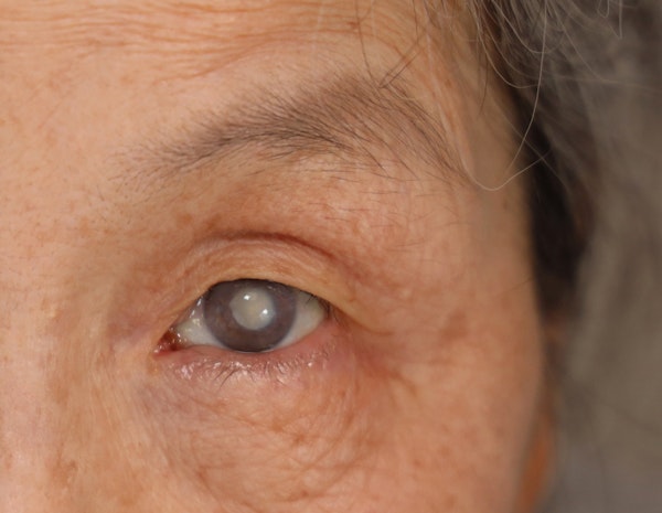 Close-up of a cataract