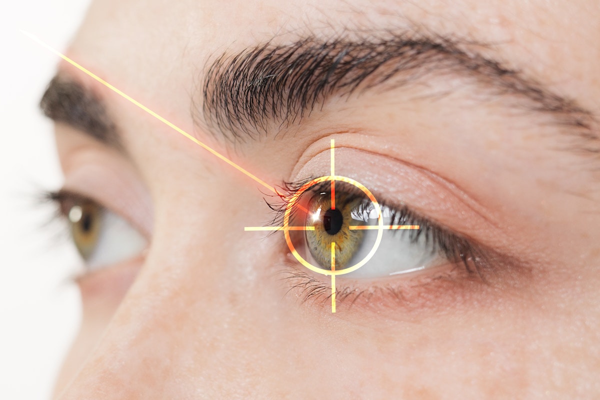 laser eye surgery
