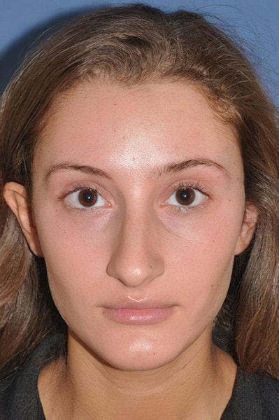 Before rhinoplasty