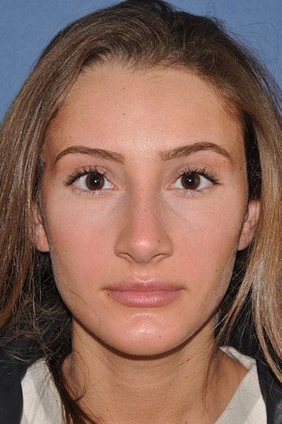 After rhinoplasty
