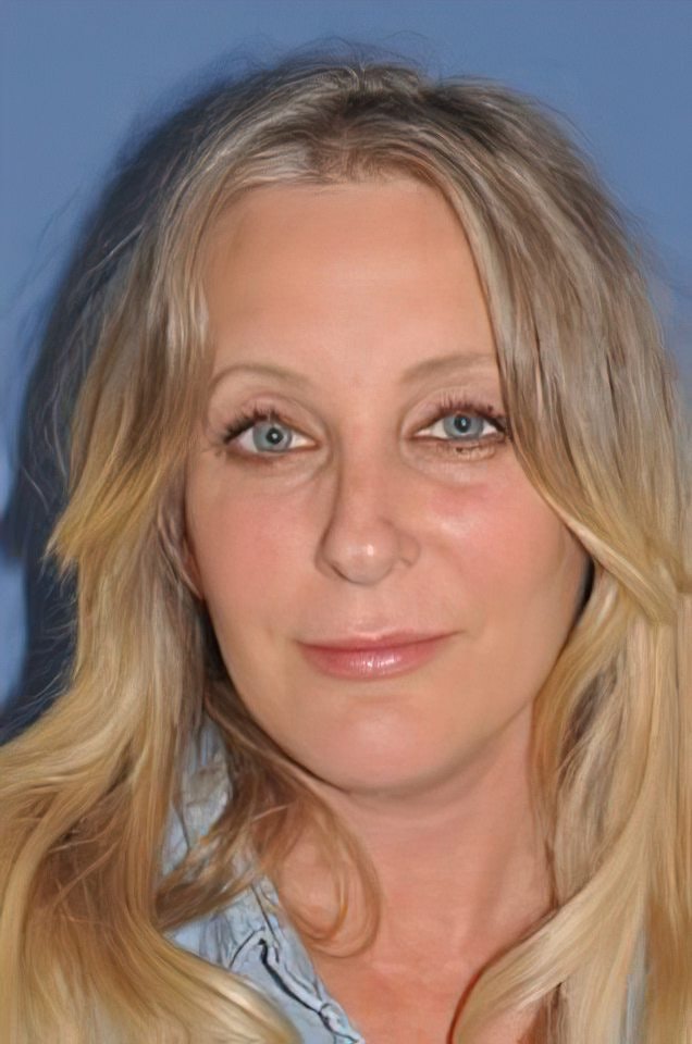 Woman after facelift