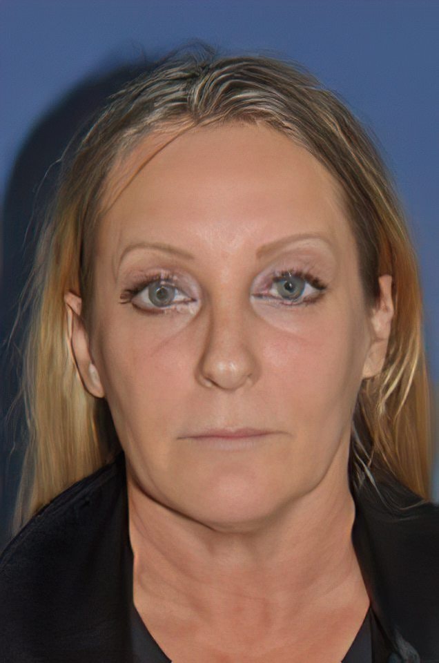 Woman before facelift