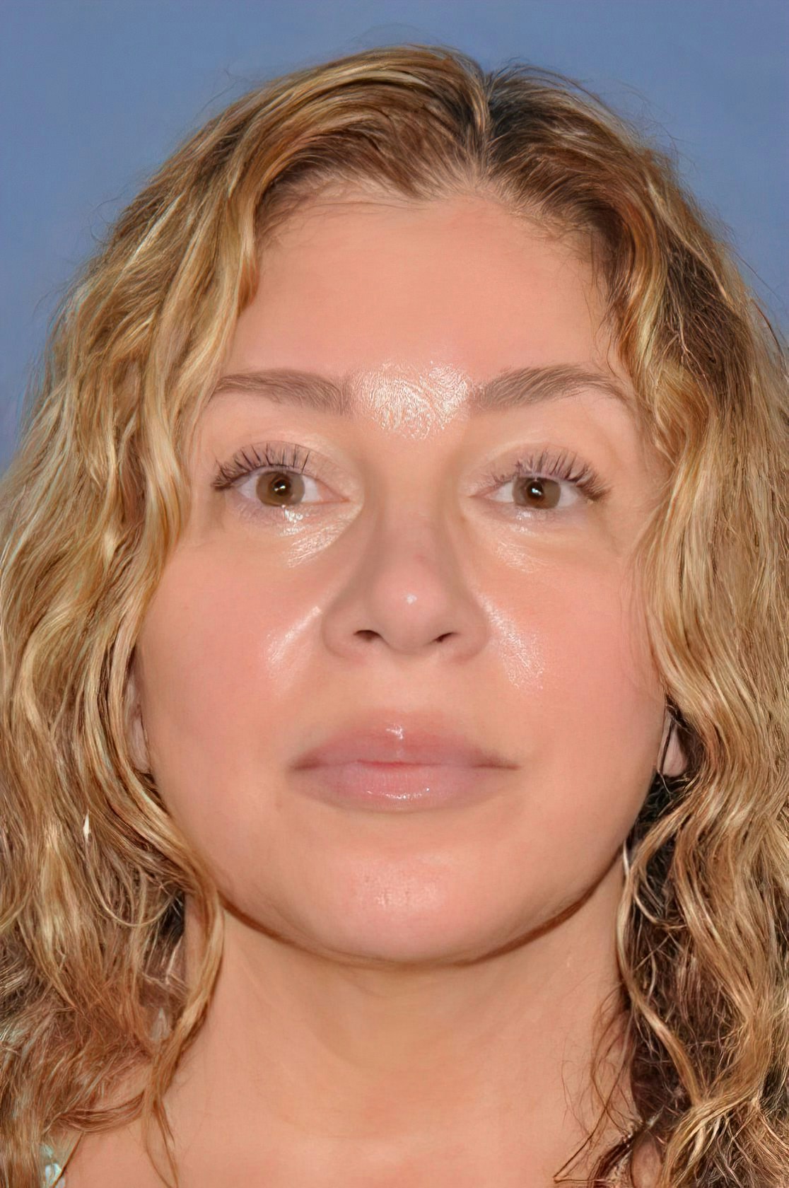 Dr. David A. Sherris's Patient After facelift